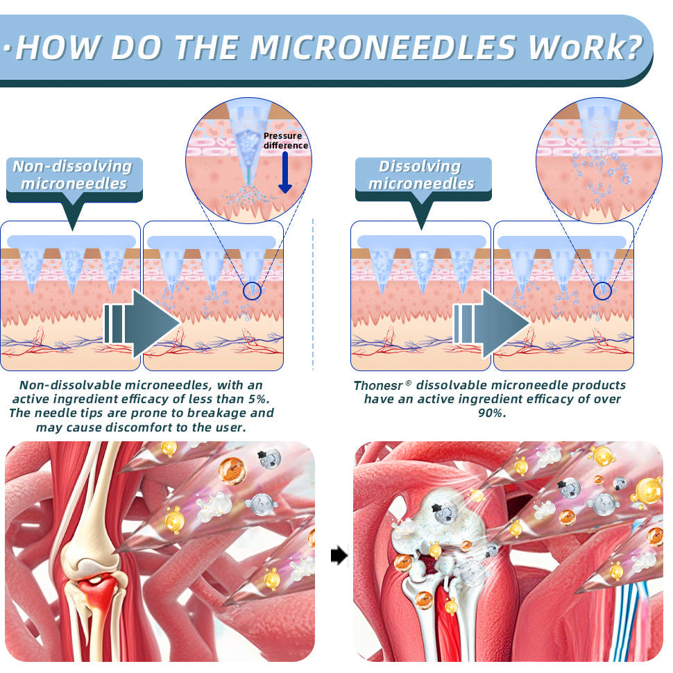 Official Store:🏃♂️➡️Thonesr® Nano-microneedle patch with HA and Horse Chestnut - for arthritis, varicose veins and various orthopedic diseases (no injections required, painless and long-lasting, visible results within 5 minutes)