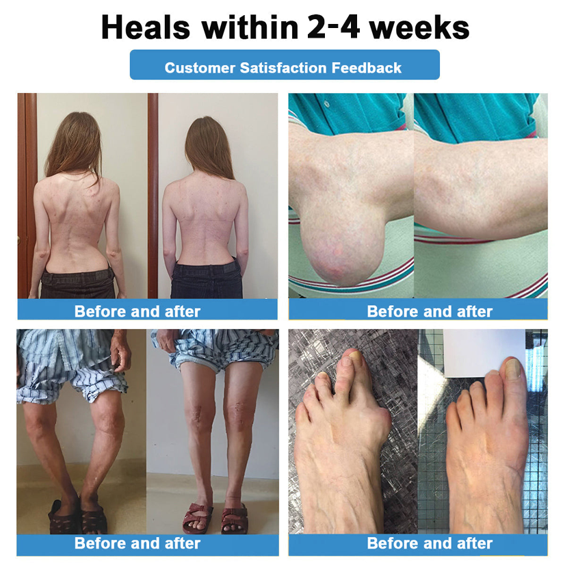 Official Store:🏃♂️➡️Thonesr® Nano-microneedle patch with HA and Horse Chestnut - for arthritis, varicose veins and various orthopedic diseases (no injections required, painless and long-lasting, visible results within 5 minutes)